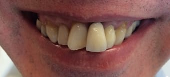 Before veneers Treatment Reading Smiles