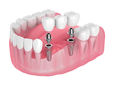 few-implants-1