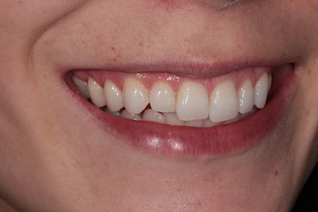 Before and After Bonding Treatment Kingston