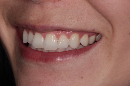 Before and After Bonding Treatment Kingston