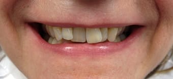 Before and After Invisalign Treatment Kingston