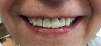 Before and After Invisalign Treatment Kingston
