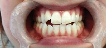 Before and After Invisalign Treatment Kingston