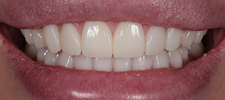 Before and After Bonding Treatment Kingston
