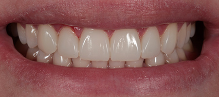 Before and After Bonding Treatment Kingston