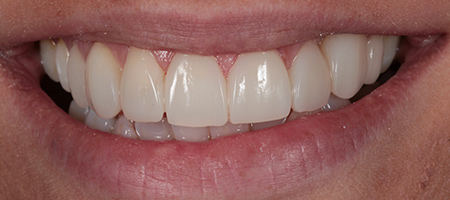 Before and After Bonding Treatment Kingston