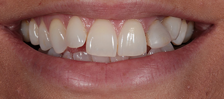 Before and After Bonding Treatment Kingston