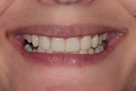 Before and After Bonding Treatment Kingston