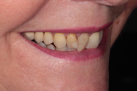 Before and After Invisalign Treatment Kingston