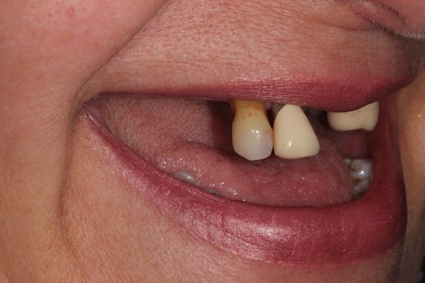 Before and After Invisalign Treatment Kingston