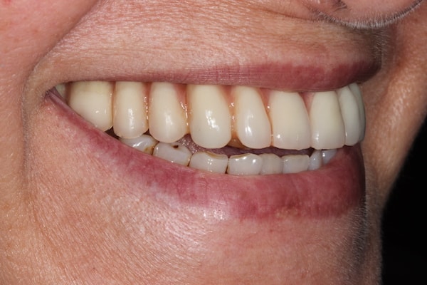 Before and After Invisalign Treatment Kingston