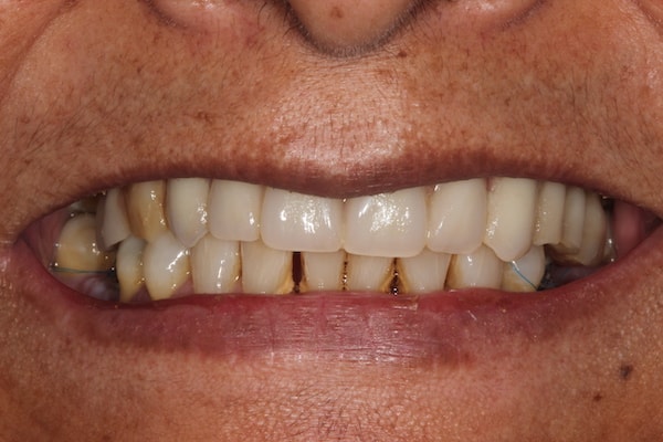 Before and After Invisalign Treatment Kingston