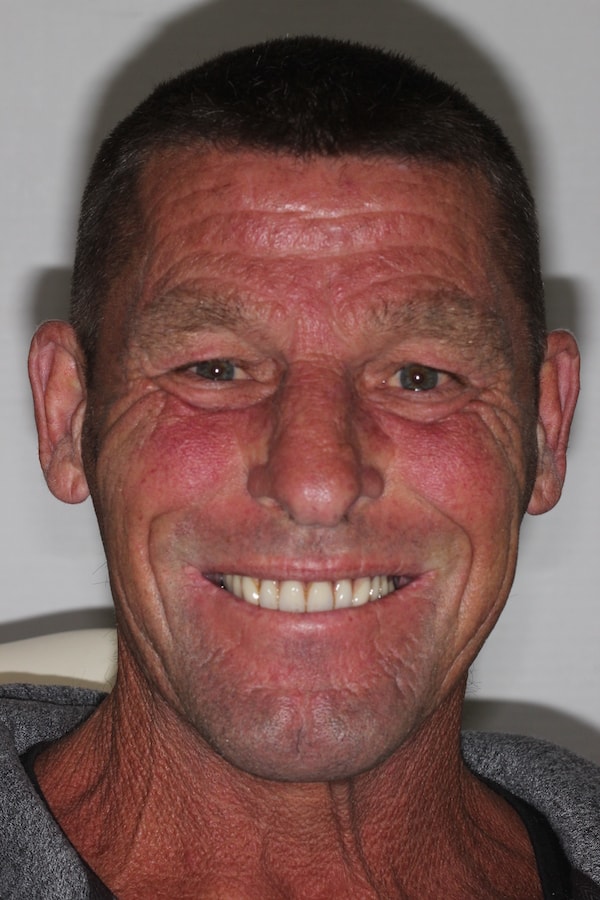 Before and After Invisalign Treatment Kingston