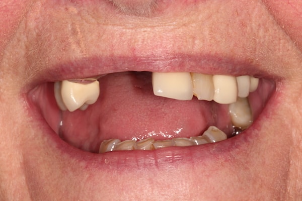 Before and After Invisalign Treatment Kingston