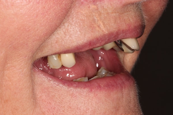 Before and After Invisalign Treatment Kingston