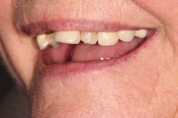 Before and After Invisalign Treatment Kingston