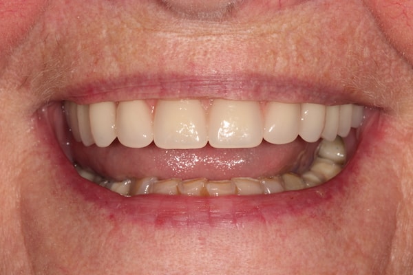 Before and After Invisalign Treatment Kingston