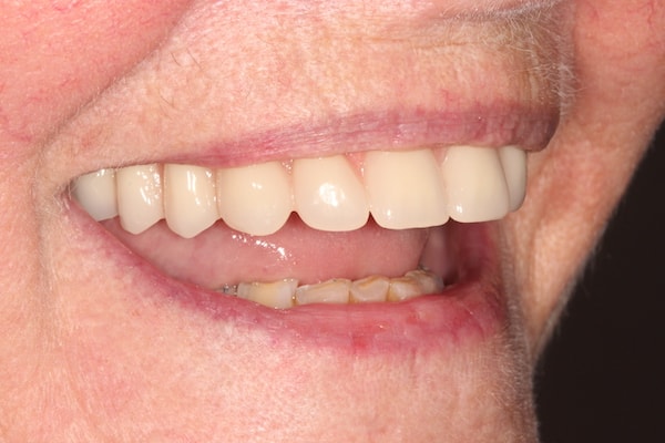 Before and After Invisalign Treatment Kingston