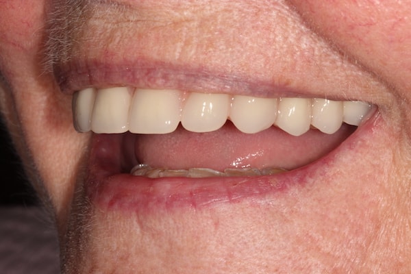 Before and After Invisalign Treatment Kingston