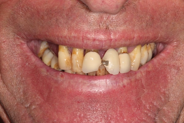 Before and After Invisalign Treatment Kingston