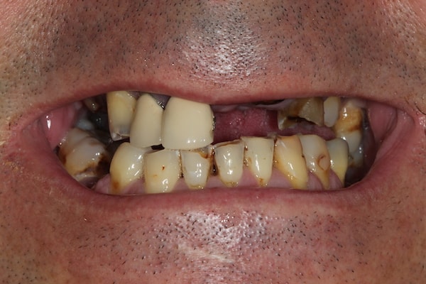 Before and After Invisalign Treatment Kingston