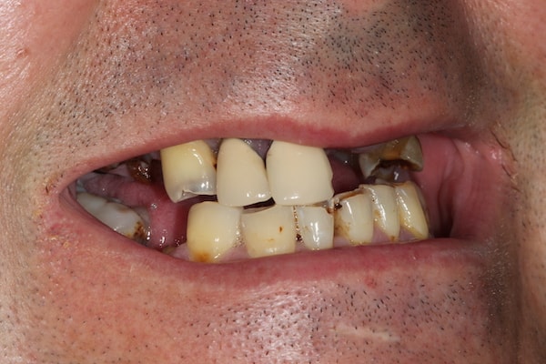 Before and After Invisalign Treatment Kingston