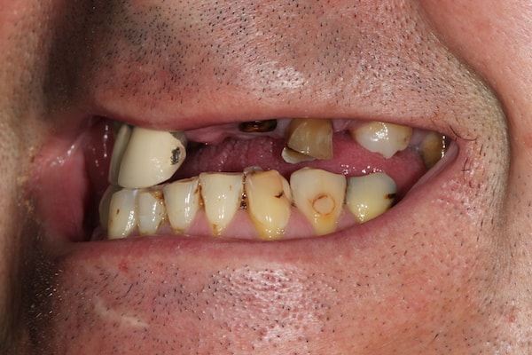 Before and After Invisalign Treatment Kingston