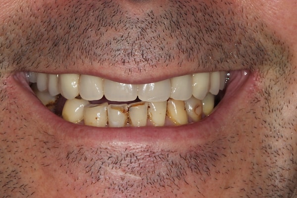 Before and After Invisalign Treatment Kingston