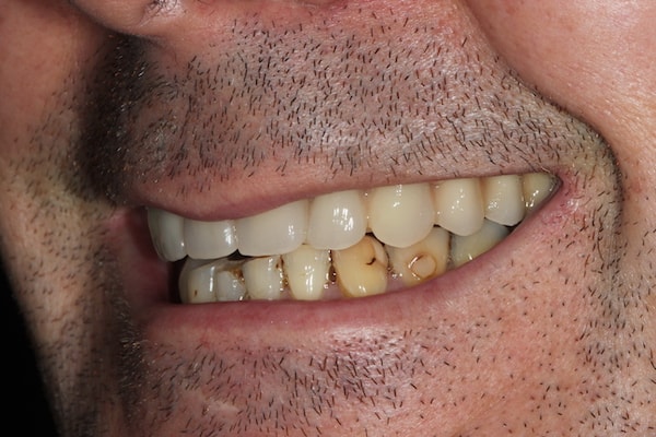 Before and After Invisalign Treatment Kingston