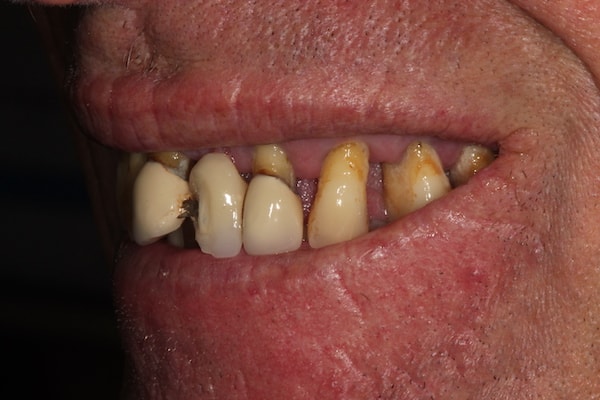 Before and After Invisalign Treatment Kingston