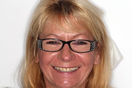Before and After Invisalign Treatment Kingston
