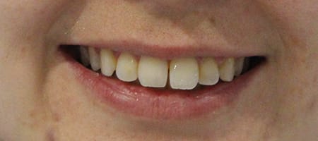 Before and After Invisalign Treatment Kingston Before and After Invisalign Treatment Kingston