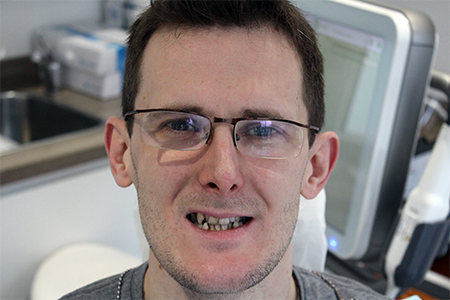 Before and After Invisalign Treatment Kingston Before and After Invisalign Treatment Kingston
