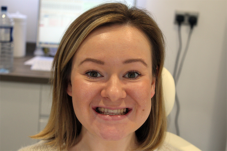 Before and After Invisalign Treatment Kingston Before and After Invisalign Treatment Kingston
