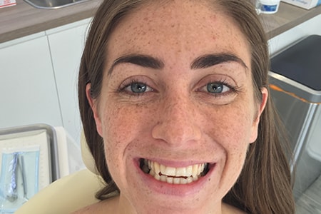 Before and After Invisalign Treatment Kingston Before and After Invisalign Treatment Kingston