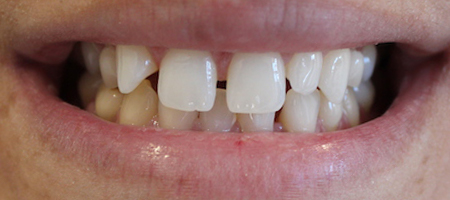 Before and After Bonding Treatment Kingston