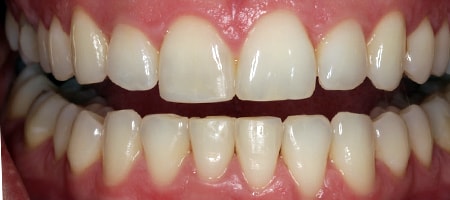 Before and After Bonding Treatment Kingston