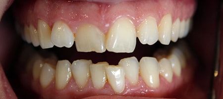 Before and After Bonding Treatment Kingston