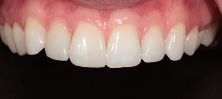 Before and After Bonding Treatment Kingston