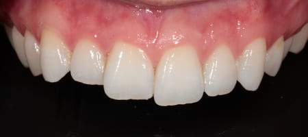 Before and After Bonding Treatment Kingston