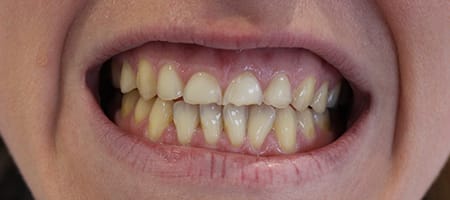 Before and After Invisalign Treatment Kingston