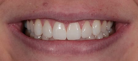 Before and After Bonding Treatment Kingston