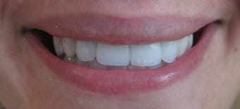 After Veneers Treatment Reading Smiles