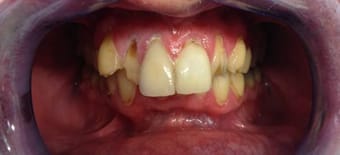 Before Smile Makeover Treatment Reading Smiles