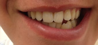 Before Smile Makeover Treatment Reading Smiles