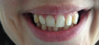 Before Smile Makeover Treatment Reading Smiles