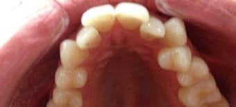 Before cosmetic Treatment Reading Smiles