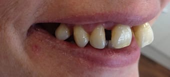 Before veneers Treatment Reading Smiles