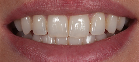 Before & after cosmetic bonding