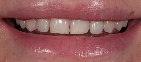 Before & after cosmetic bonding